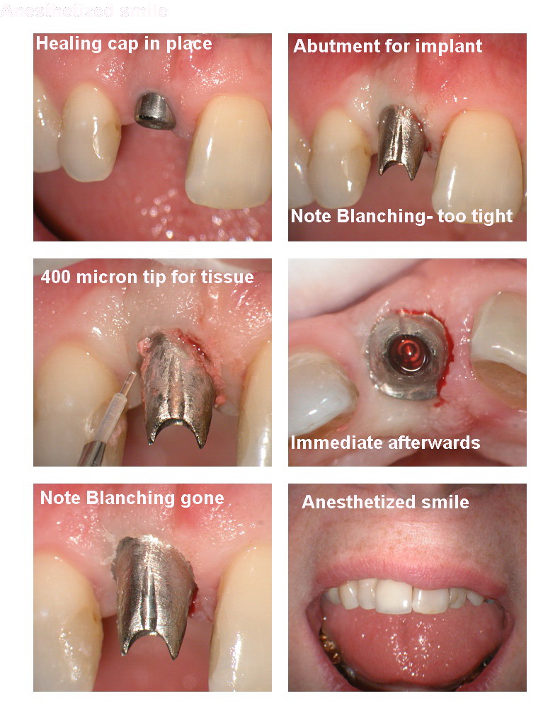 Implant pg 2.jpg